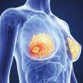 Best Breast Cancer Treatment In Noida By Dr Manish Singhal