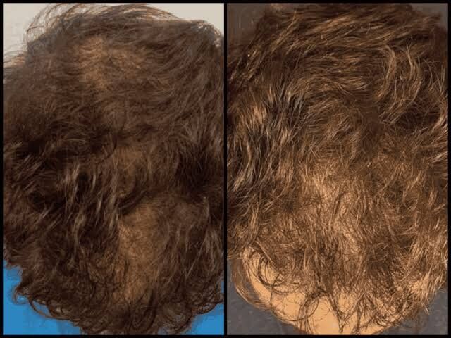 Dallas, Business, Hair Loss Solutions Dallas | Women&rsquo;s Thinning Hair Specialist