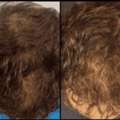 Hair Loss Solutions Dallas | Women&rsquo;s Thinning Hair Specialist