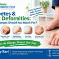 Diabetes & Foot Deformities: What Changes Should You Watch For? - Dr Uday Ravi