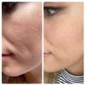 Struggling With Enlarged Pores & AC Texture? AFFORD CLINIC IN DUBAI