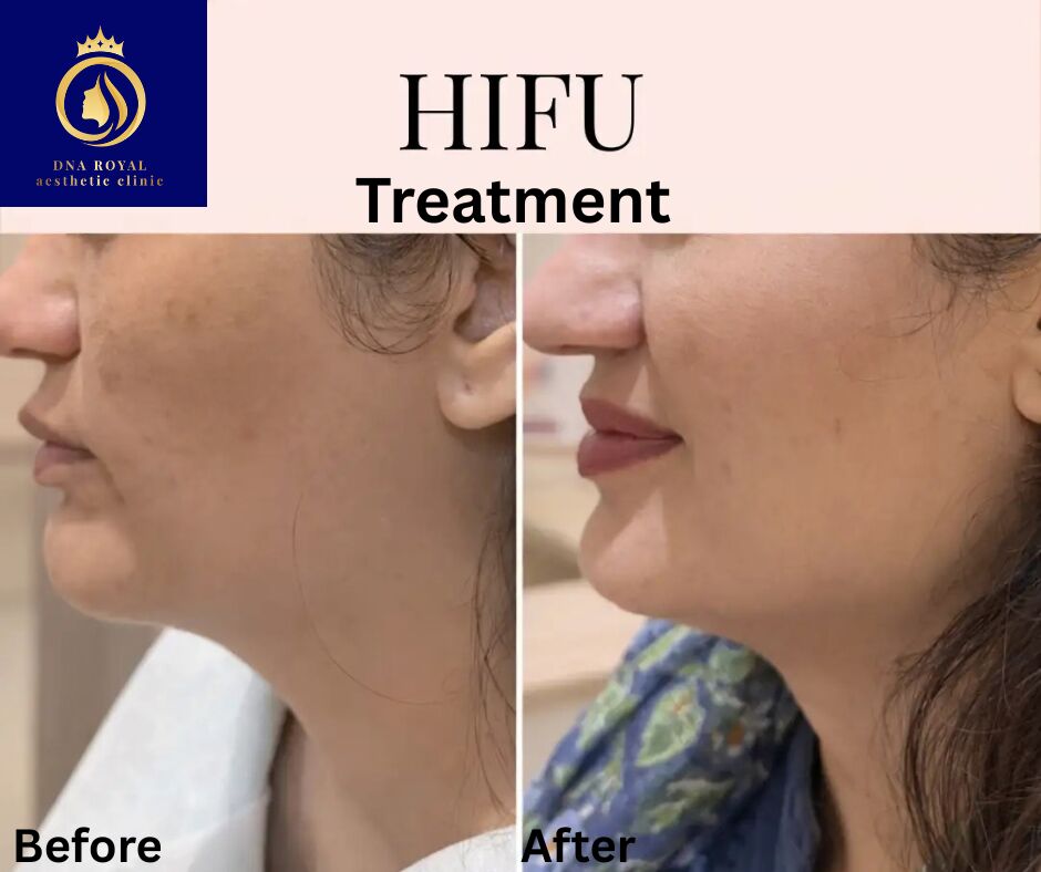 Thane, Fashion & Design, Advanced HIFU Treatment In Thane | Skin Rejuvenation At DNA Royal.