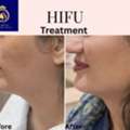 Advanced HIFU Treatment In Thane | Skin Rejuvenation At DNA Royal.