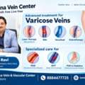 Advanced Treatment Options For Varicose Veins & Vascular Conditions In Bangalore
