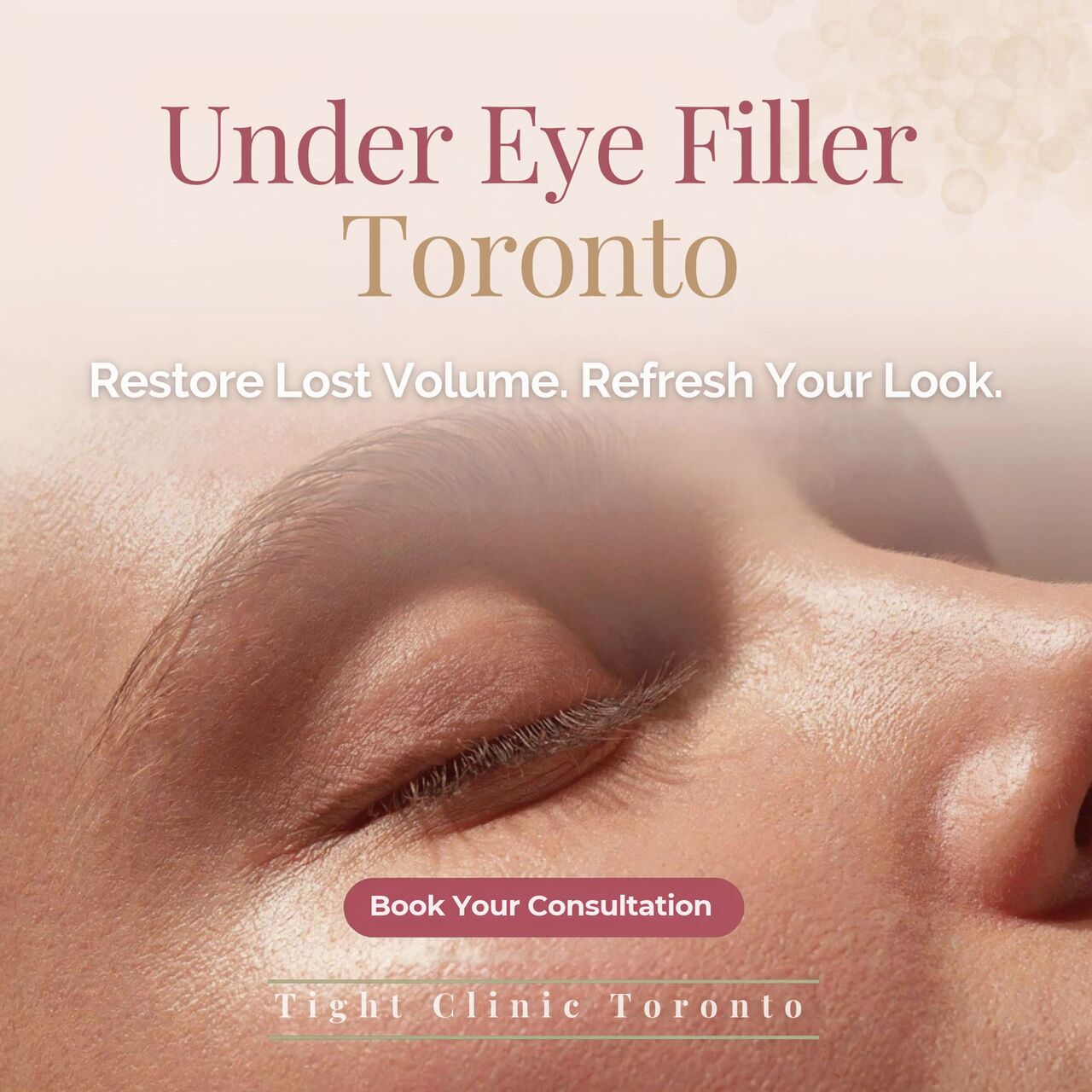 Toronto, Beautician, Under Eye Filler Toronto | Tear Trough Treatment | Tight Clinic