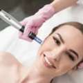 RF Microneedling Treatment