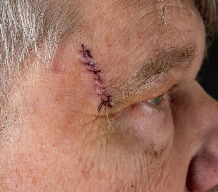 New York, Health, Expert Skin Cancer Surgery And Treatment Services In California