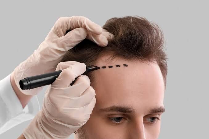 Melbourne, Health, Trusted Hair Transplant Doctor In Melbourne &ndash; Dr. Haror&rsquo;s Wellness