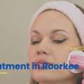 Melasma Treatment In Roorkee