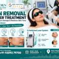 INR 2500,  Tan Removal Laser Treatment In Jaipur For Sun-Damaged And Uneven Skin