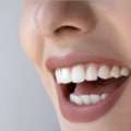 Tooth Color Fillings In Mount Roskill