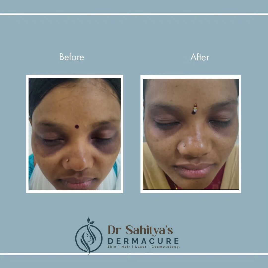 Kurnool, Health, Best Dark Circles Treatment At Dermacure By Dr Sahitya Reddy