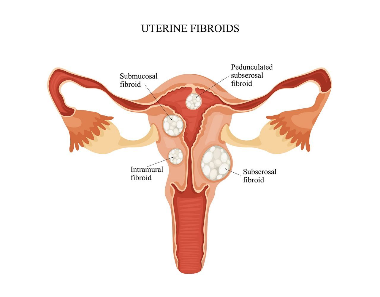 New Delhi, Health, Detailed Uterine Evaluation In Delhi By Fertility Experts