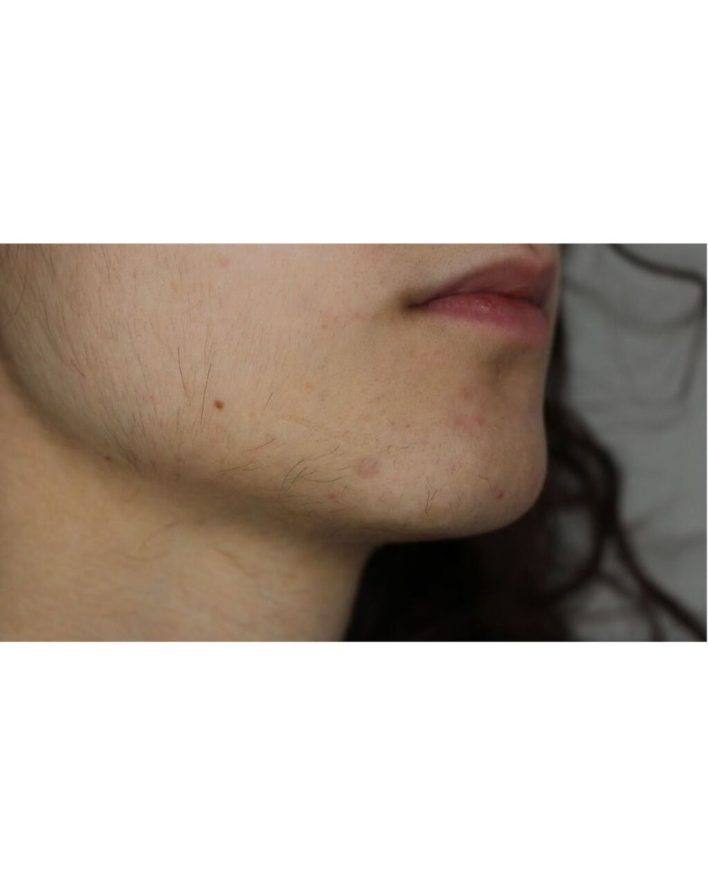 New York, Business, PCOS Facial Hair Removal