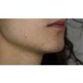 PCOS Facial Hair Removal