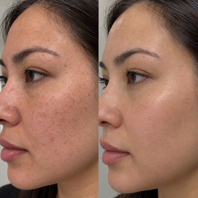 Toronto, Beautician, PRP Treatment In Toronto For Natural-Looking Skin Renewal