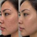 PRP Treatment In Toronto For Natural-Looking Skin Renewal