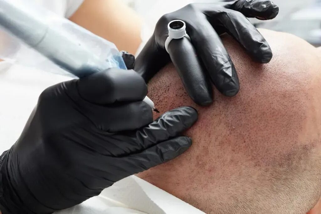 New York, Beautician, Scalpmasters - Scalp Micropigmentation Hair Clinic