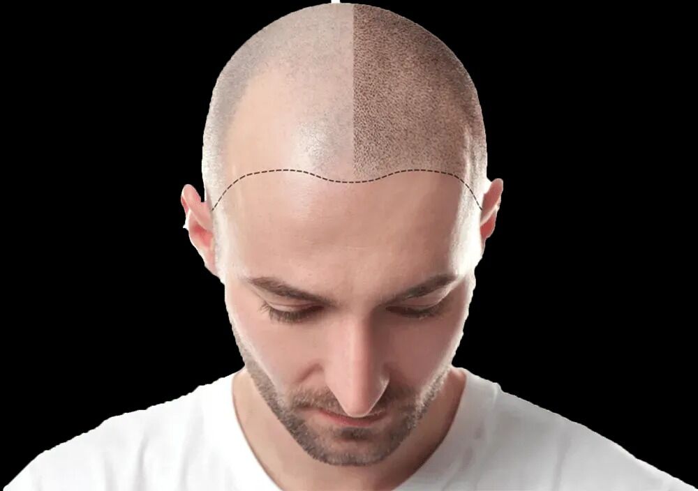 New York, Beautician, Scalpmasters - Scalp Micropigmentation Hair Clinic
