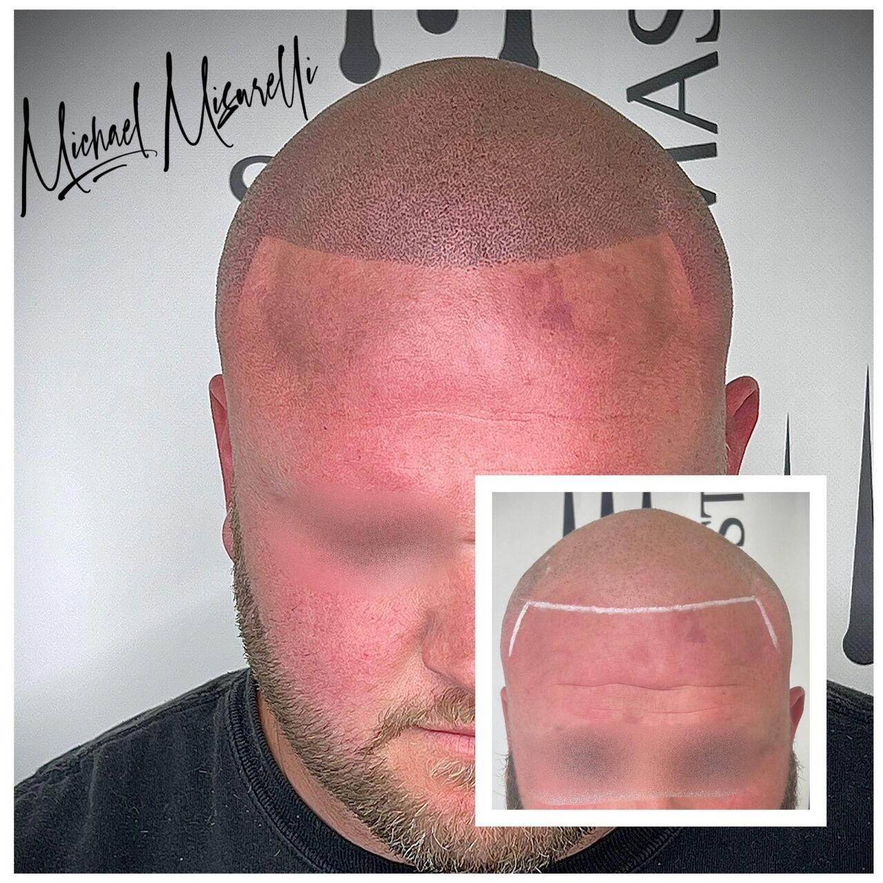New York, Beautician, Scalpmasters - Scalp Micropigmentation Hair Clinic