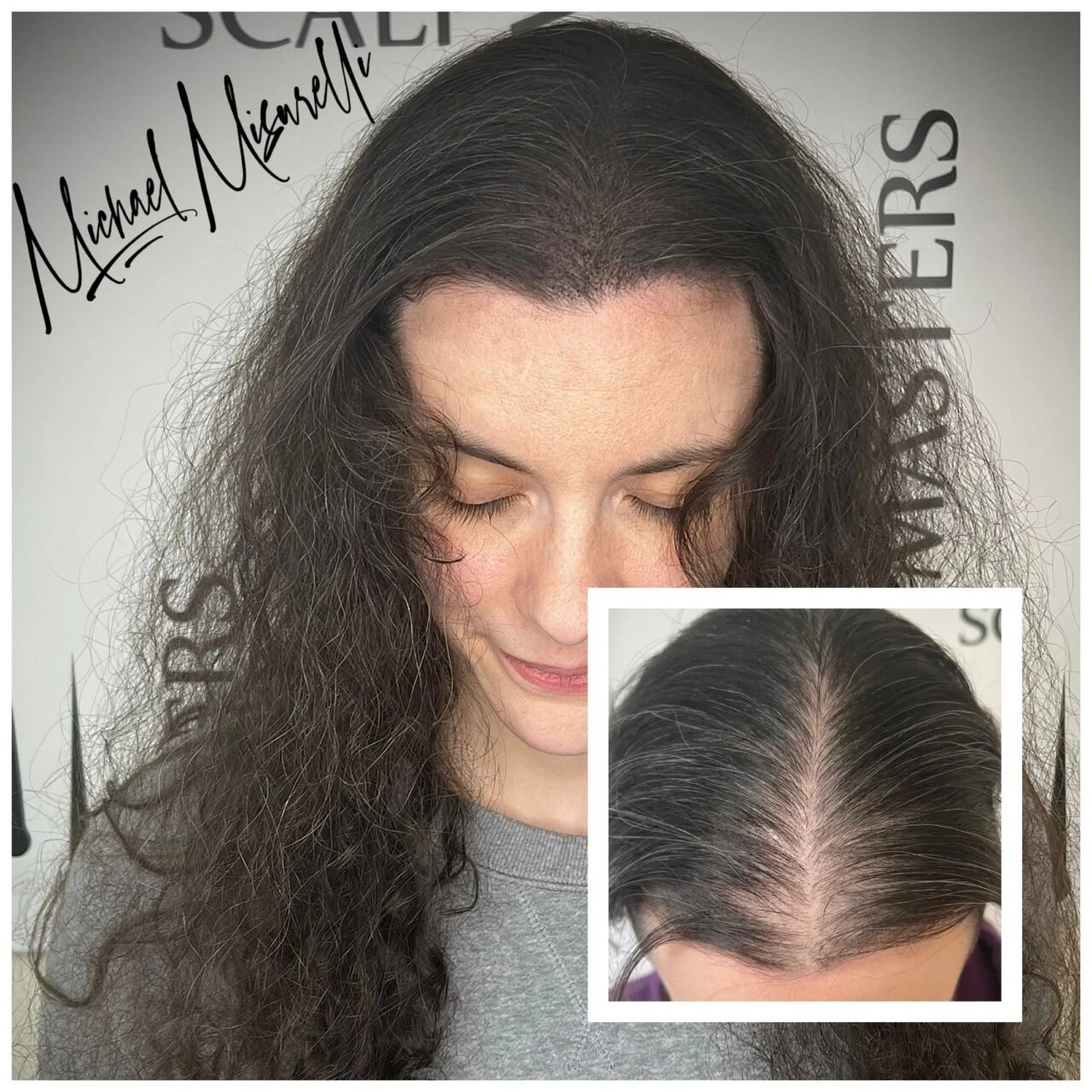 New York, Beautician, Scalpmasters - Scalp Micropigmentation Hair Clinic