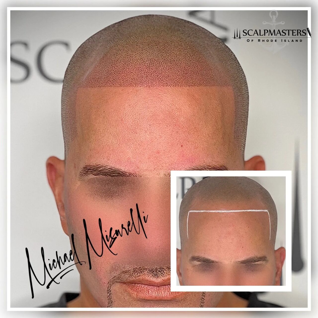 New York, Beautician, Scalpmasters - Scalp Micropigmentation Hair Clinic