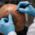 Trusted Hair Transplant In Chennai | Clear Pricing & Expert Care