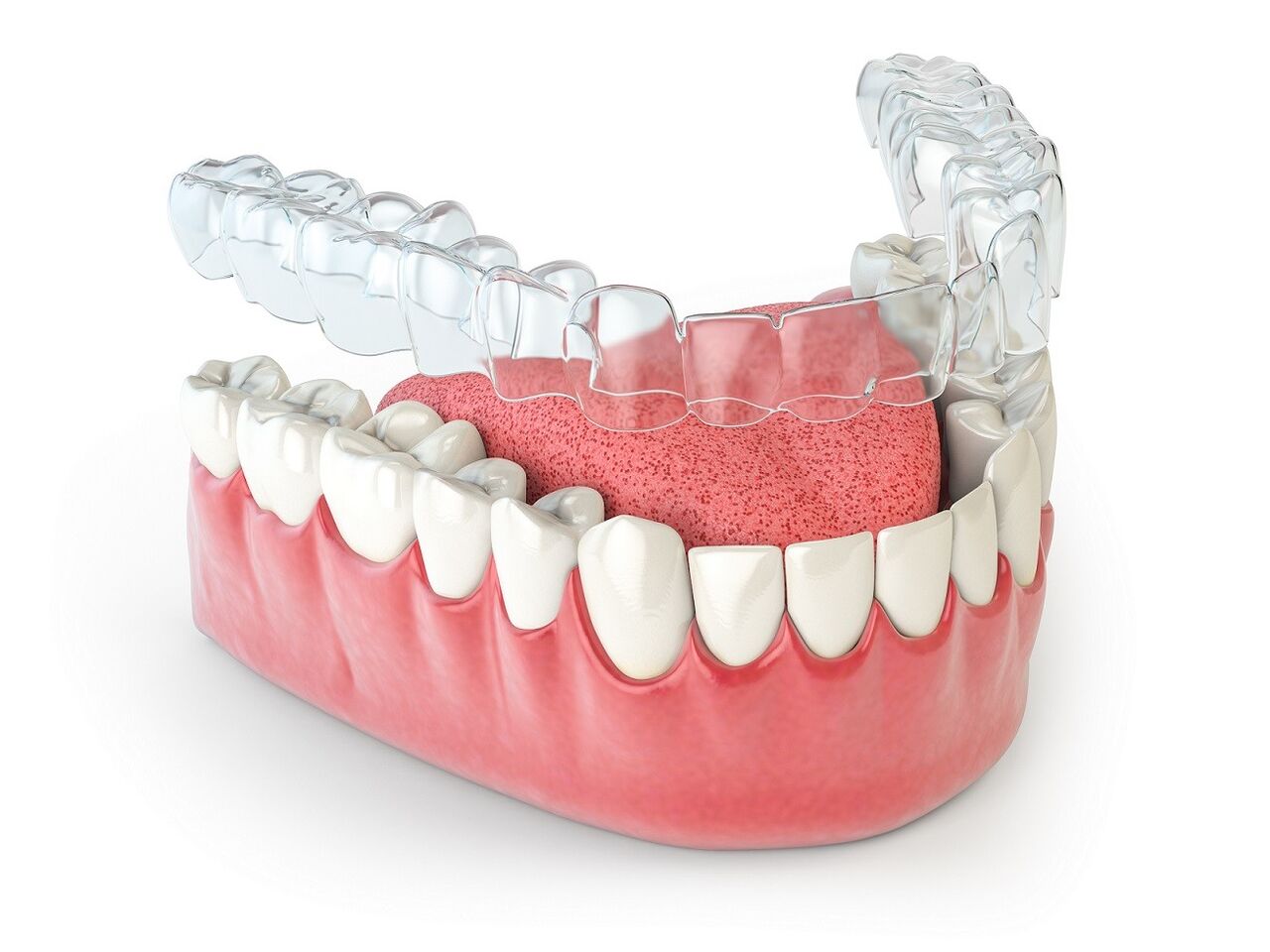 Pune, Dental, Invisalign Treatment In NIBM Pune | Clear Aligners