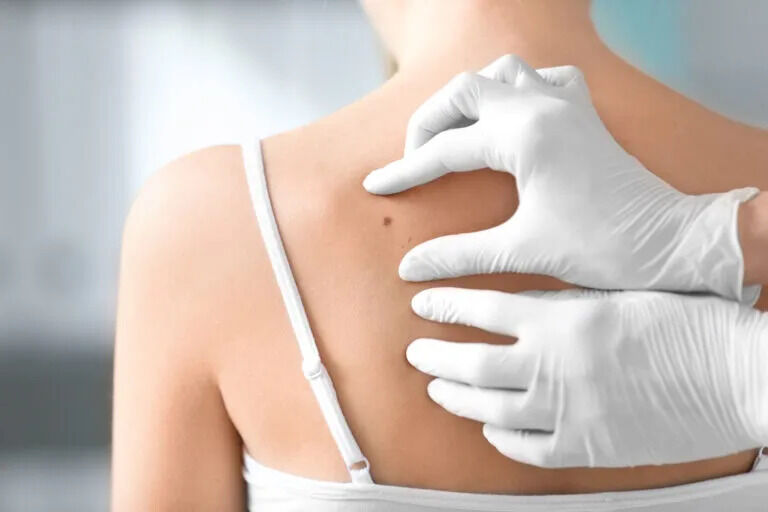 New York, Health, Expert Nevus Dermatology Services Available In Temecula