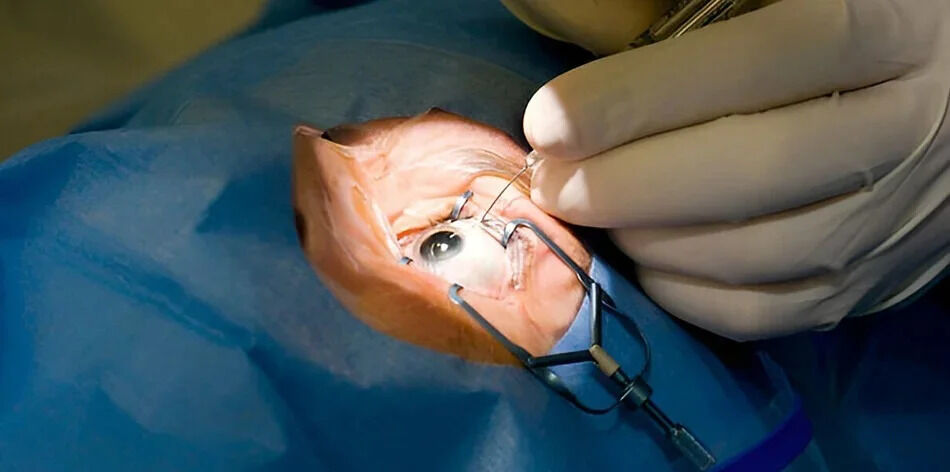 Faridabad, Health, Cataract Surgery In Faridabad For Clearer Vision