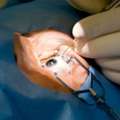 Cataract Surgery In Faridabad For Clearer Vision