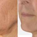 Chemical Peel Dermatologist Mississauga