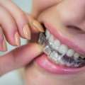 Invisalign In Borivali: How Clear Aligners Work