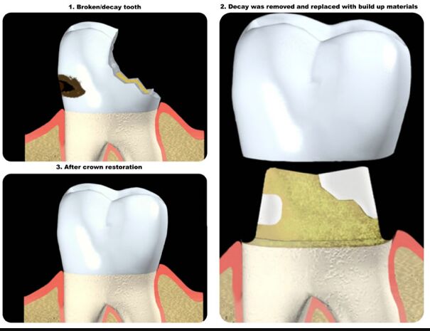 New York, Dental, Same-Day Crowns For A Beautiful, Restored Smile | Berkeley Lake Dental