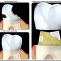 Same-Day Crowns For A Beautiful, Restored Smile | Berkeley Lake Dental