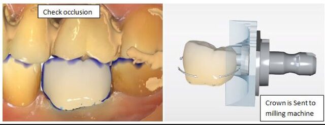 New York, Dental, Same-Day Crowns For A Beautiful, Restored Smile | Berkeley Lake Dental