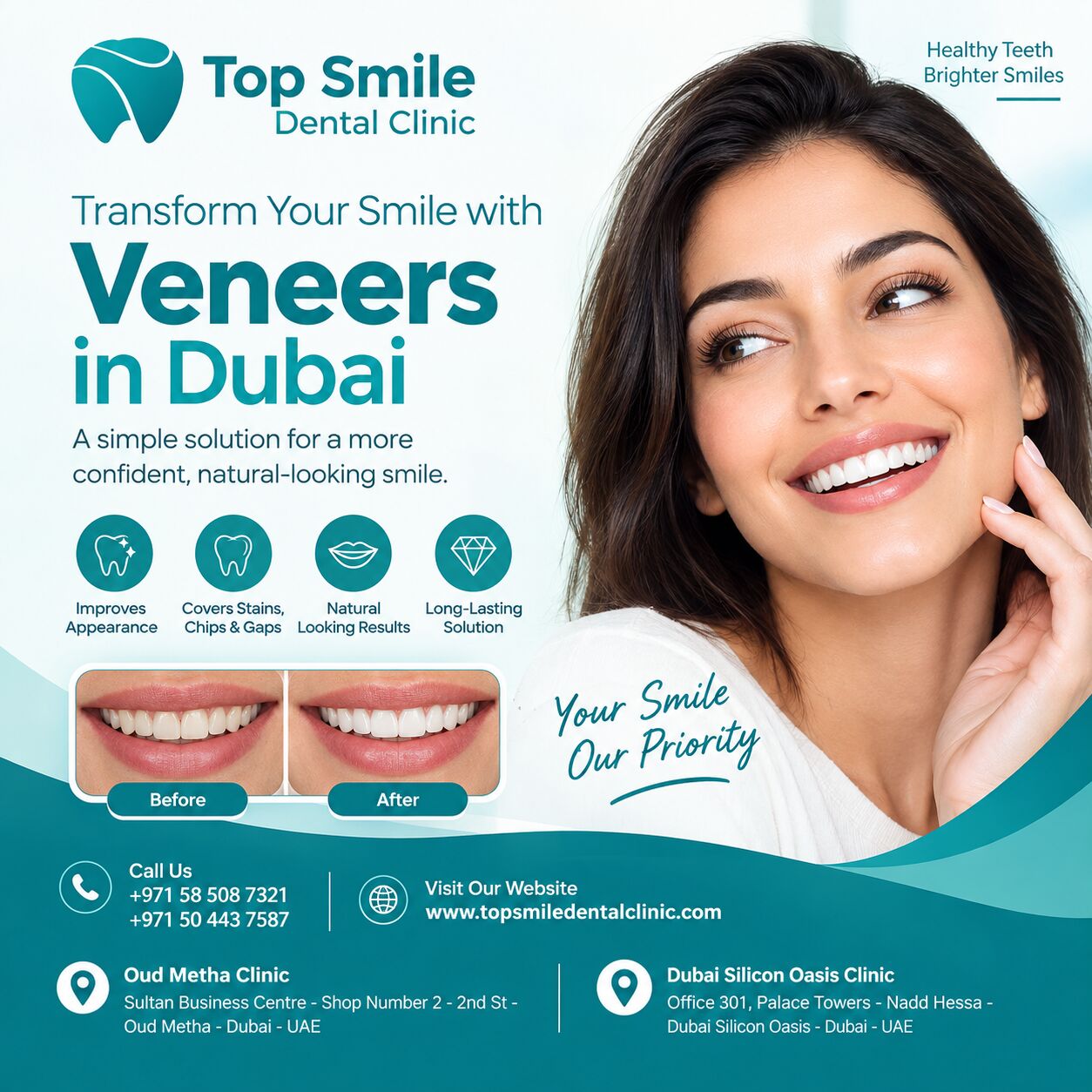 Dubai, Dental, Veneer Dubai &ndash; Dental Veneers At Top Smile Dental Clinic