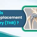 Struggling To Walk Because Of Hip Pain? Learn About Hip Replacement | Dr. Divyesh Bukalsar