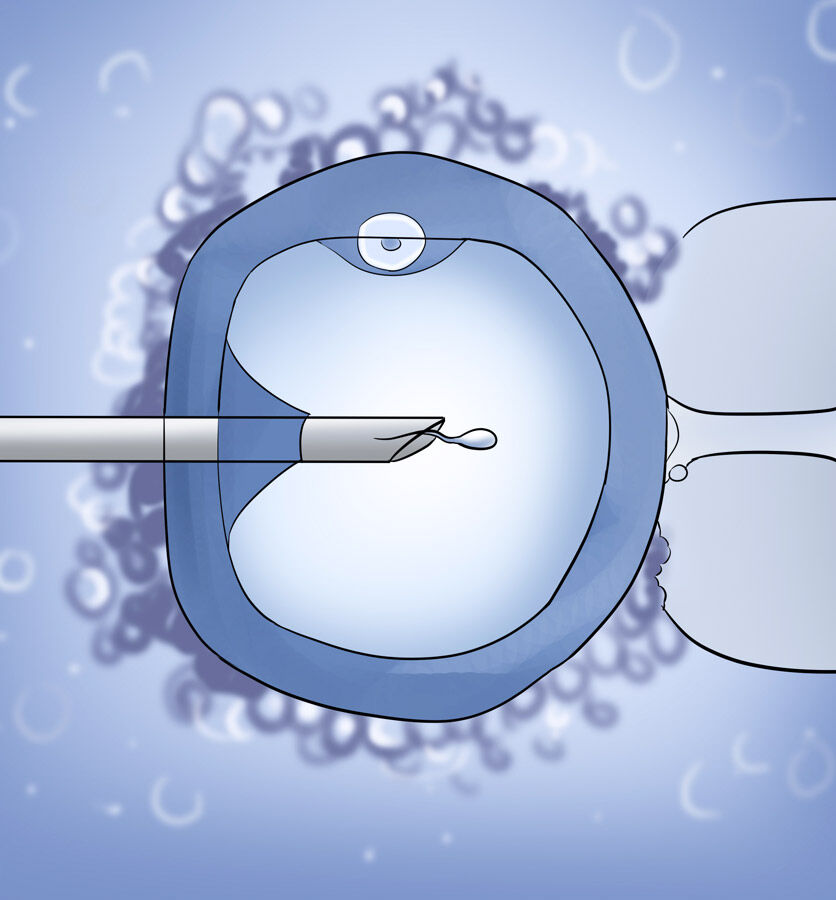 Delhi, Health, Expert ICSI Male Treatment In Delhi | Fertylity IVF