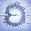 Expert ICSI Male Treatment In Delhi | Fertylity IVF
