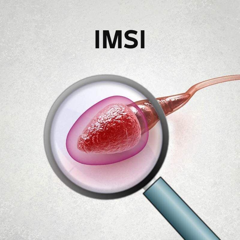 Delhi, Health, Advanced IMSI Treatment In Delhi For Male Fertility Care