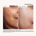 INR 549,  How To Choose A Face Oil For Acne Prone Skin Without Clogging Pores