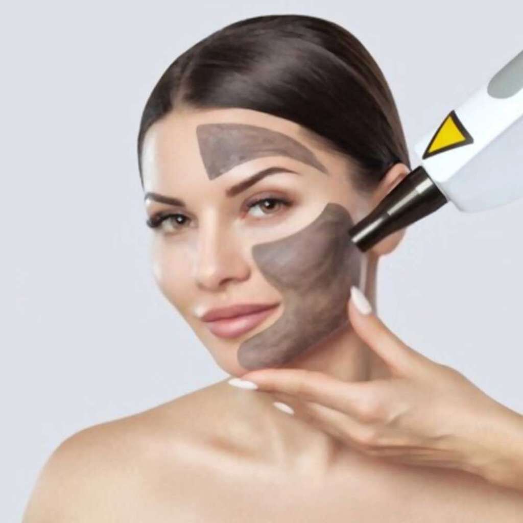 New Delhi, Health, Carbon Facial Treatment In Delhi