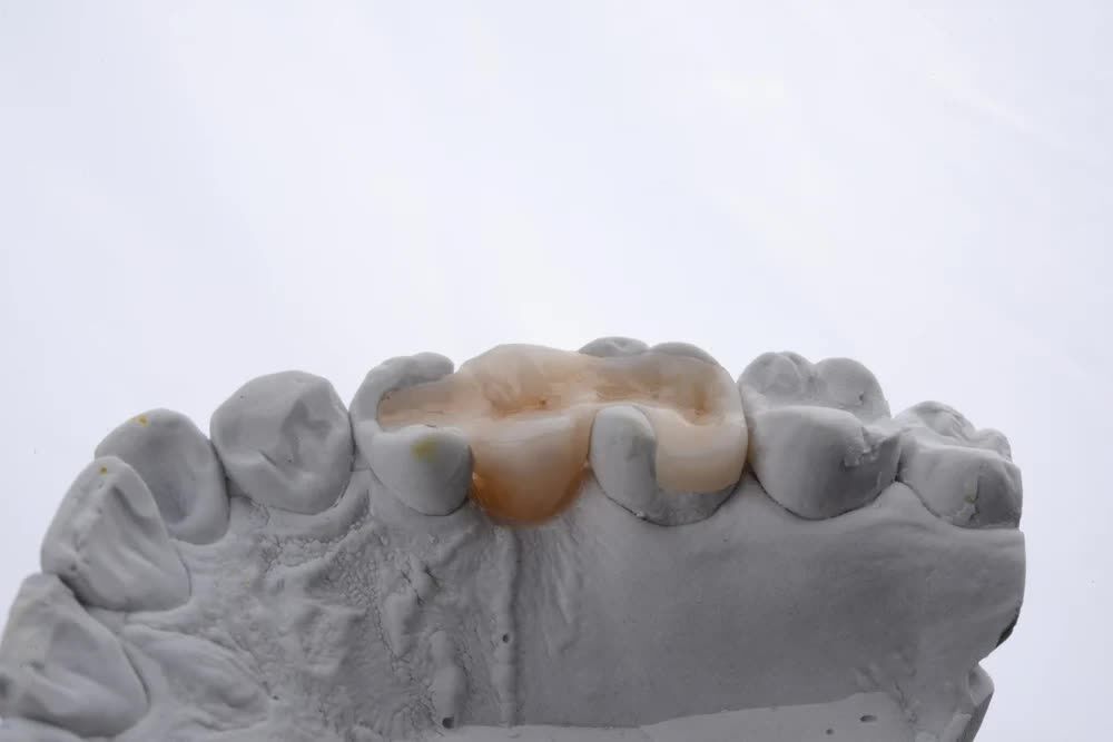 Chicago, Health, Inlays & Onlays: Restore Damaged Teeth With Confidence