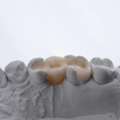 Inlays & Onlays: Restore Damaged Teeth With Confidence