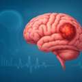 Best Brain Cancer Doctor In Noida For Expert Care