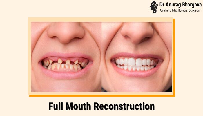 Indore, Health, Full Mouth Reconstruction: Restore Your Smile | Dr. Anurag Bhargava