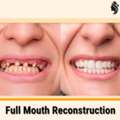 Full Mouth Reconstruction: Restore Your Smile | Dr. Anurag Bhargava