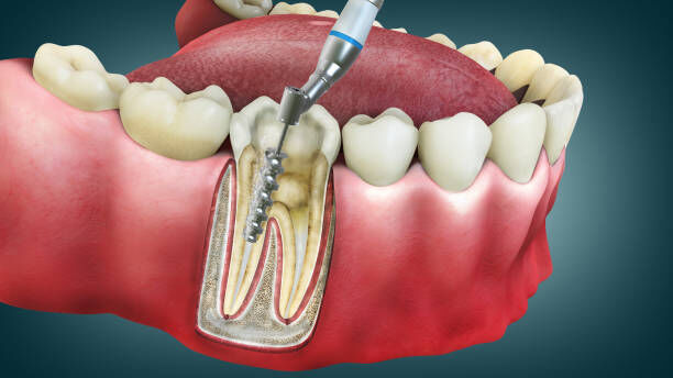 Thane, Dental, Root Canal Cost In Thane | Agrawal Dental Clinic