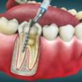 Root Canal Cost In Thane | Agrawal Dental Clinic